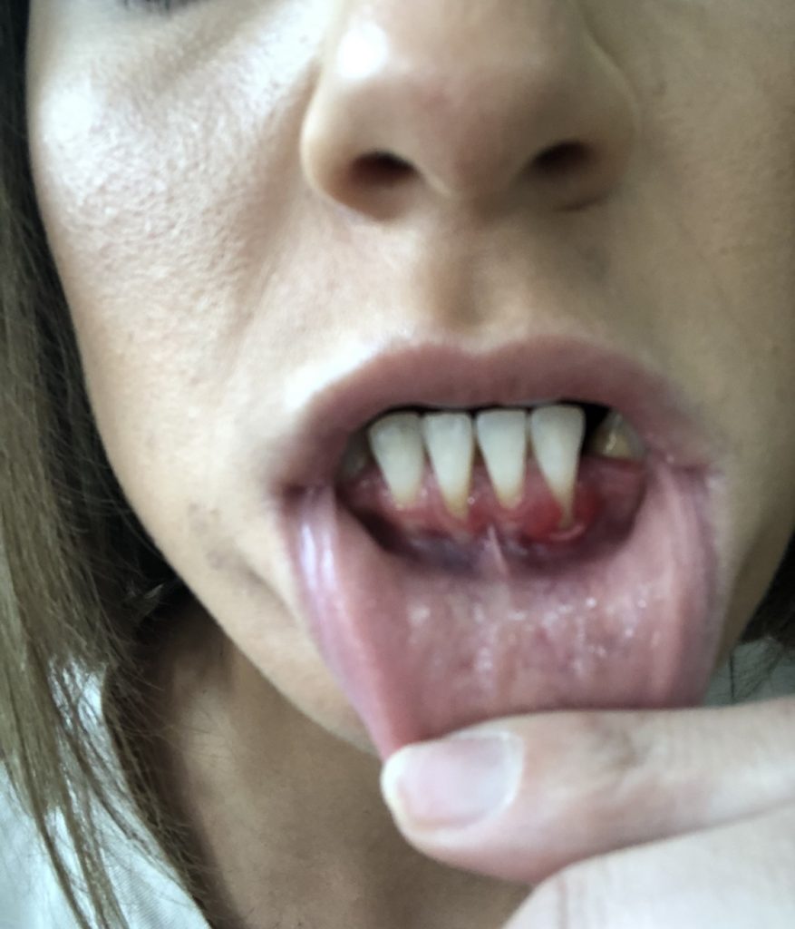 Women with phobia of dentist left traumatised after botched procedure for new teeth