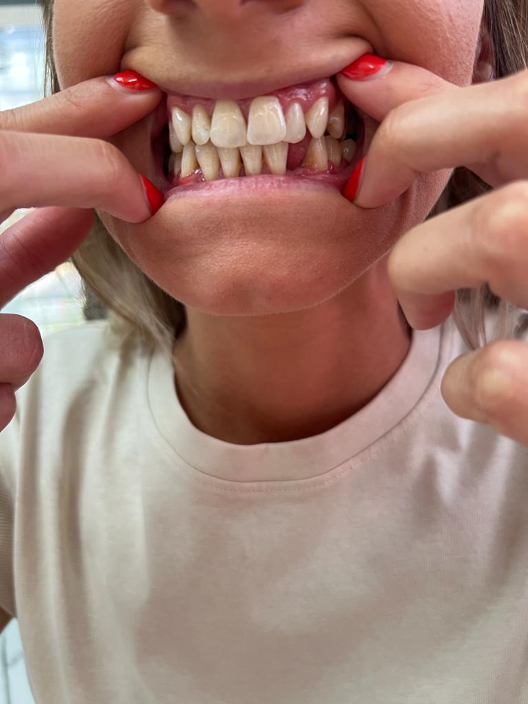 Women with phobia of dentist left traumatised after botched procedure for new teeth